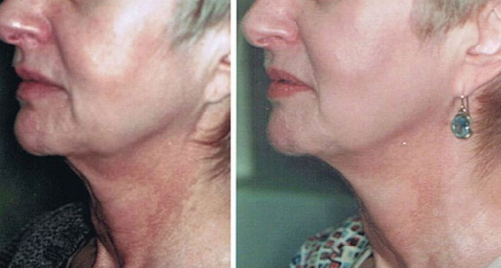 Dr. Judith Hellman - NYC Skin Tightening & Non-Surgical Facelift Expert