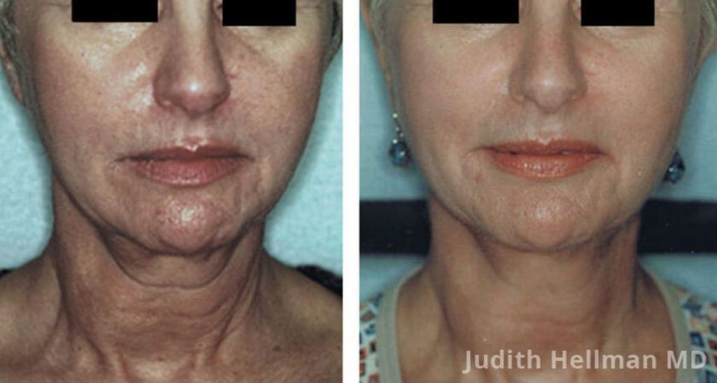 Dr. Judith Hellman - NYC Skin Tightening & Non-Surgical Facelift Expert