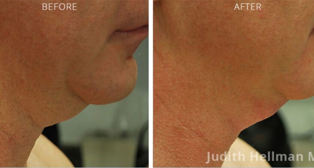Non-surgical jowl lifting NYC - Dr. Hellman